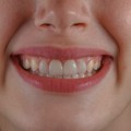 Impianto dentale a Novara e Varese: come cambia il sorriso dopo un impianto dentale